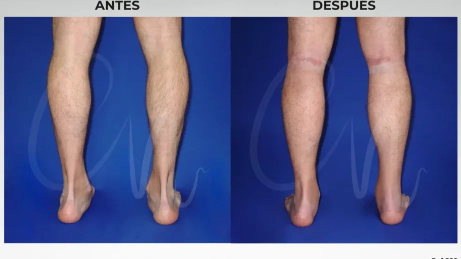 Implantes musculares para hombres: todo lo que necesitas saber